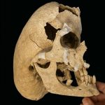 600 illik cəngavərdə nadir "Kruzon" sindromu aşkar edildi